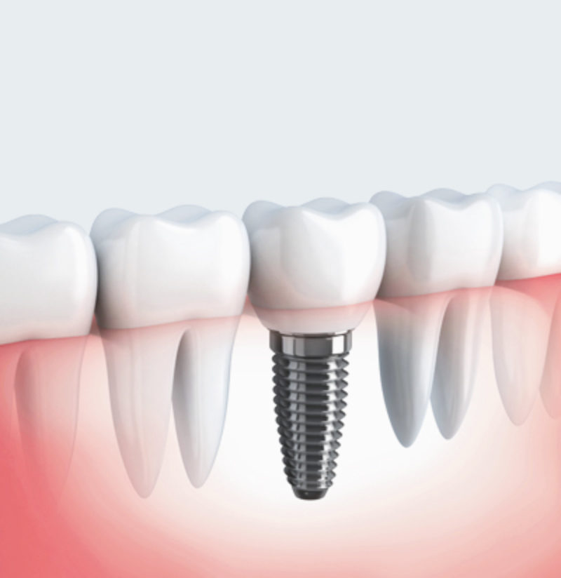 dental implant Manchester