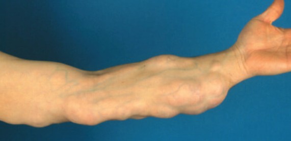 botox treatment Tustin CA