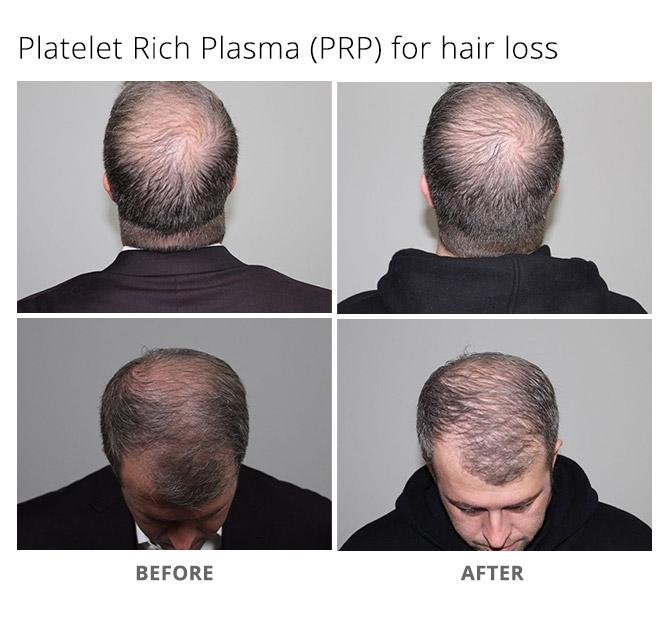 platelet rich plasma hair loss treatment New Jersey